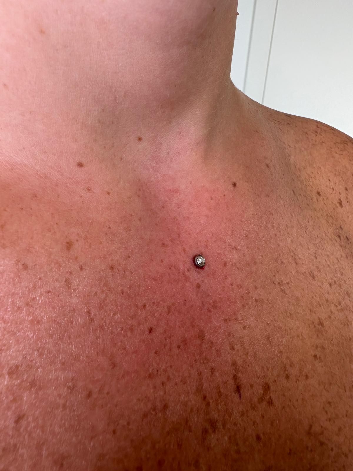 Microdermal sul décolleté